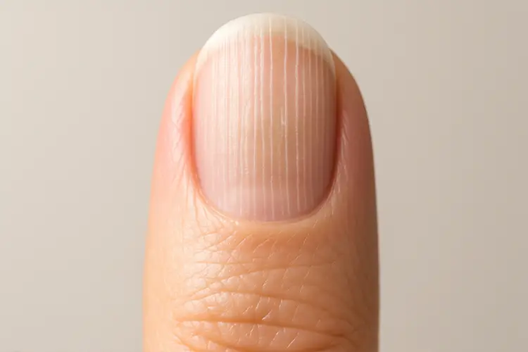 Ongles abîmés : signes d’alerte à ne pas négliger - Carence en fer : une cause fréquente d’ongles abîmés