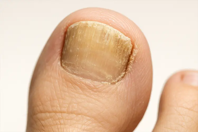 Ongles abîmés : signes d’alerte à ne pas négliger - Ongle jaunâtre et cassé, en gros plan, avec légende “Mycose unguéale”