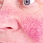 Rosacée : causes, soins et laser vasculaire visage