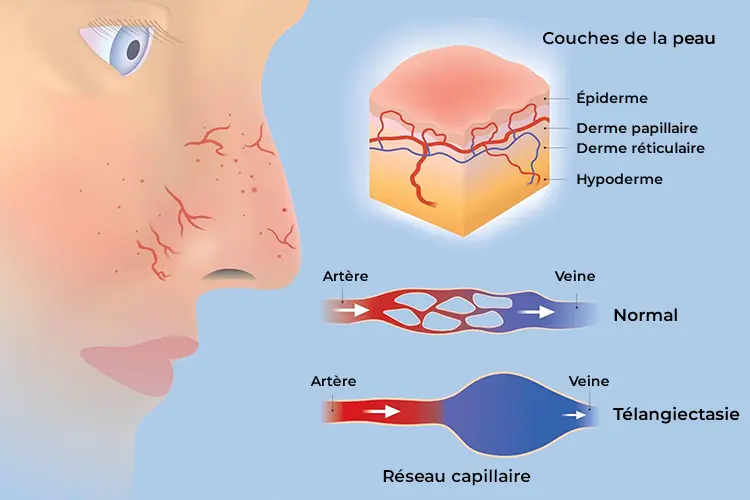 Rosacée : causes, soins et laser vasculaire visage - Schéma explicatif montrant la dilatation des vaisseaux sanguins dans la peau