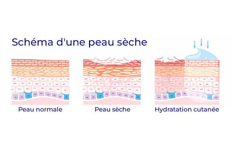 Hydrater sa peau : conseils d’un médecin esthétique - illustration comparative d’une peau hydratée vs. une peau sèche au microscope