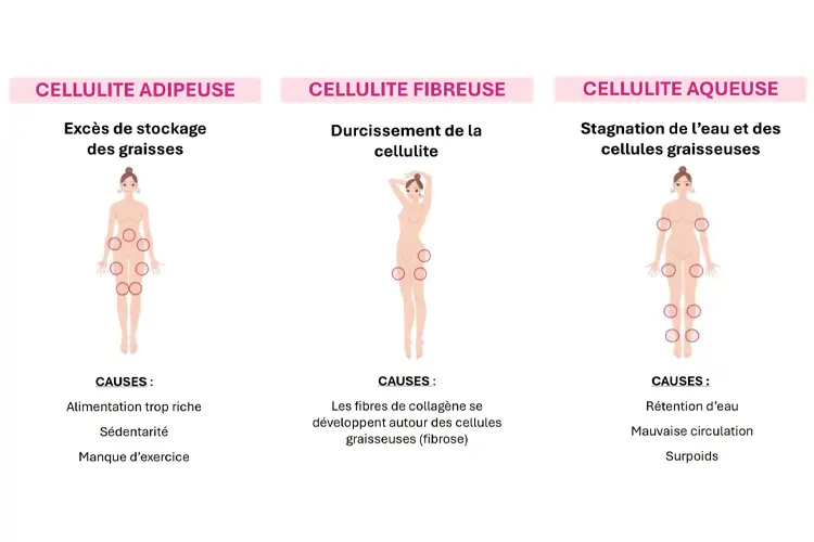 Traitements efficaces contre la cellulite - tableau comparatif des trois types de cellulite avec photos indicatives