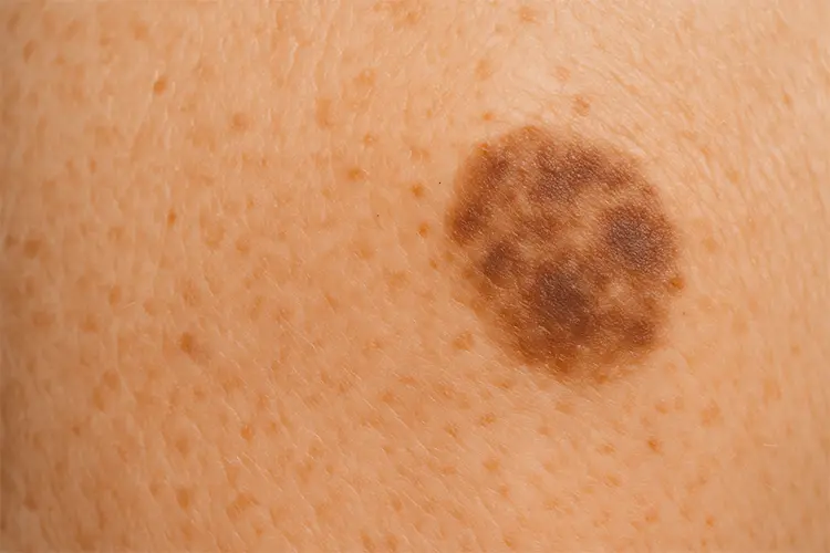 Taches pigmentaires : causes, prévention et traitements - photo en gros plan d’un lentigo solaire sur la peau mature