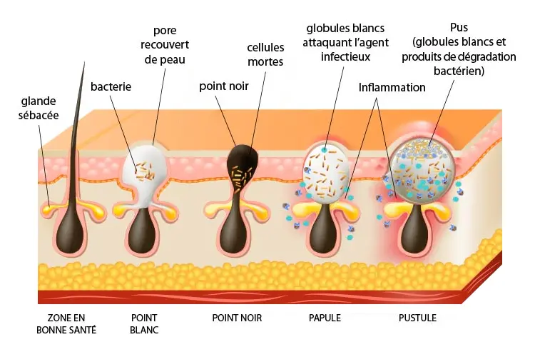 Traitement acné : conseils d’un médecin esthétique - schéma illustrant l'origine de l’acné – hormones, glandes sébacées, bactéries