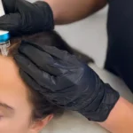 Chute de cheveux : traitements efficaces